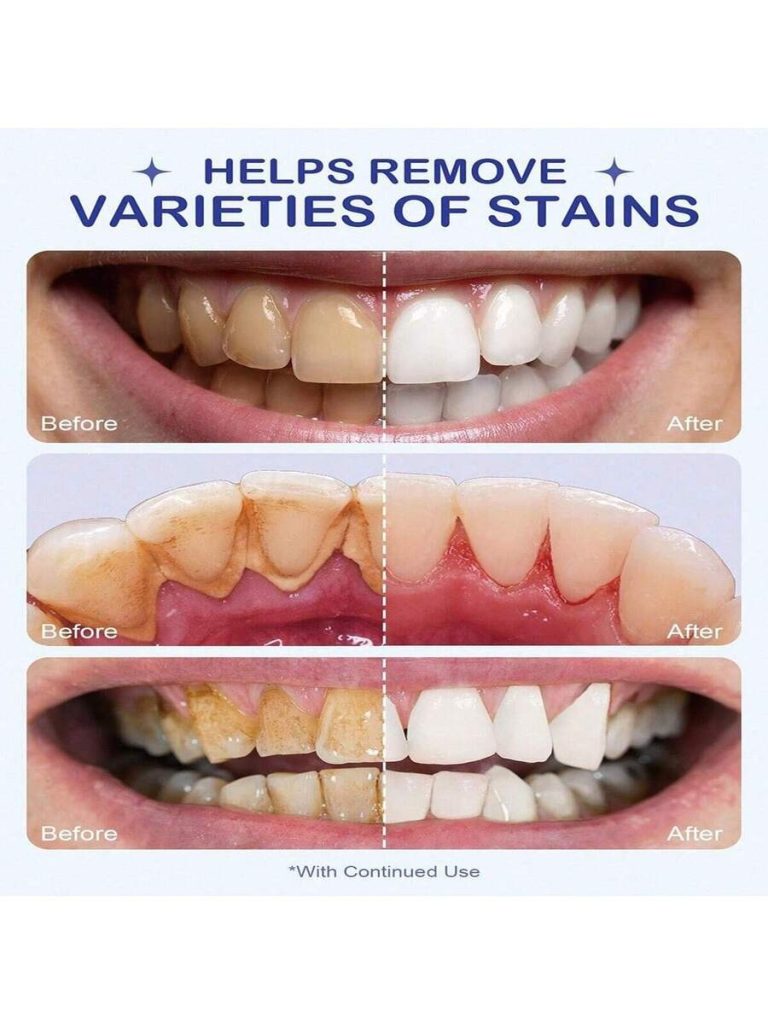 Teeth Whitening Kit Deeply Moisturizes Hydrates Skin Long Lasting Brightness Enhanced Elasticity Vitality Boosting Formula For Radiant Smile - Image 4